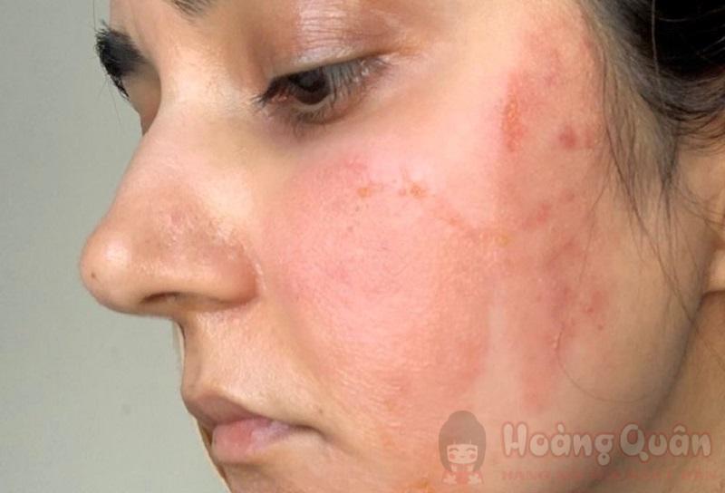 peel da bị bỏng phải làm sao