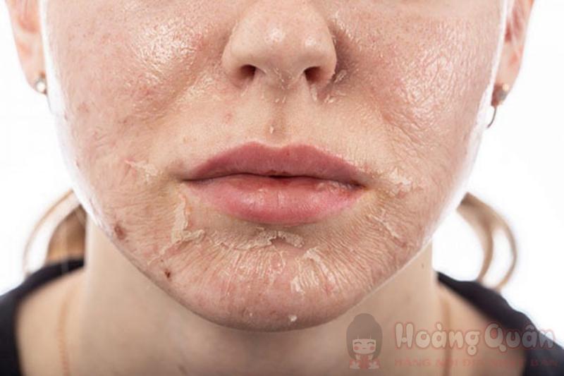 peel da nhiều có tốt hay không