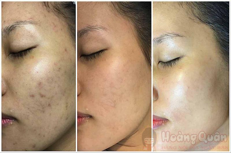tác dụng Peel da vi tảo là gì