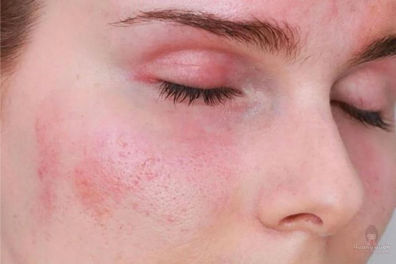 nguyên nhân dị ứng kem chống nắng