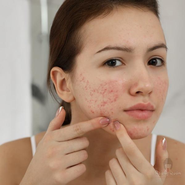 tại sao dùng kem chống nắng bị nổi mụn