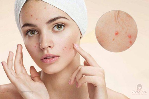 tại sao dùng kem chống nắng bị mụn